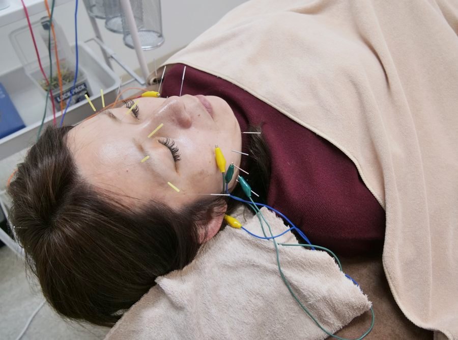 仰向けで顔と首に鍼をしている様子
